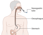 NG Tube