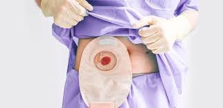 stoma bag