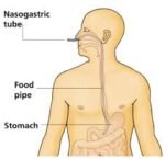 NG Tube