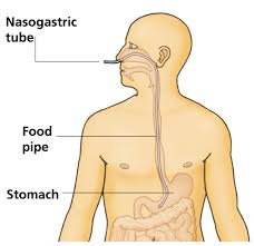 NG Tube